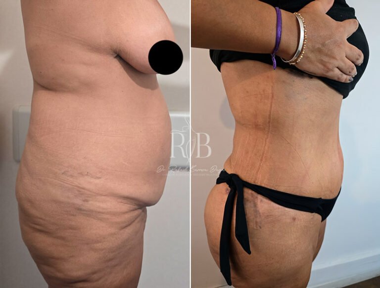 Resultados de dermolipectomía abdominal, eliminando la piel sobrante y grasa para un abdomen más plano y tonificado