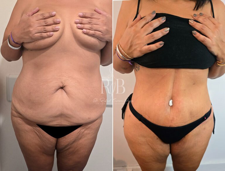 Paciente mostrando los resultados de dermolipectomía abdominal, con eliminación de exceso de piel y grasa para un contorno más definido.