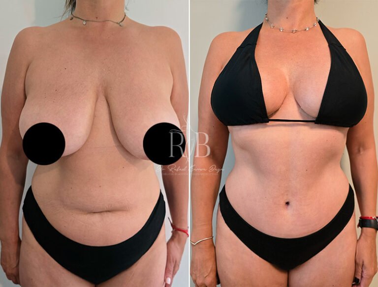 Imagen mostrando el contorno mejorado tras lipoescultura realizada por Dr. Rafael Barrera, resaltando un abdomen esculpido