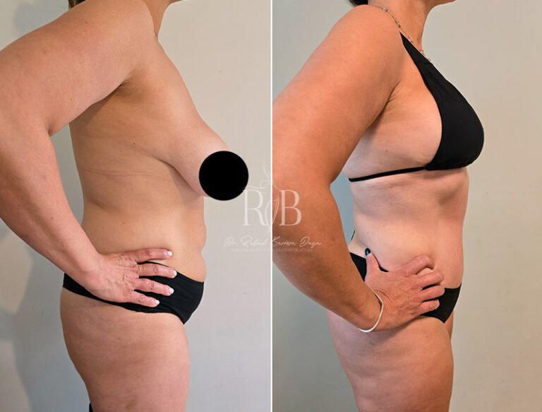 Vista cercana de los resultados de aumento mamario, con un enfoque en la simetría y naturalidad lograda por Dr. Rafael Barrera