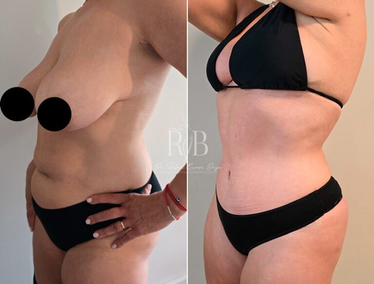 Paciente mostrando los resultados de lipoescultura en abdomen y flancos realizados por Dr. Rafael Barrera, contorno definido