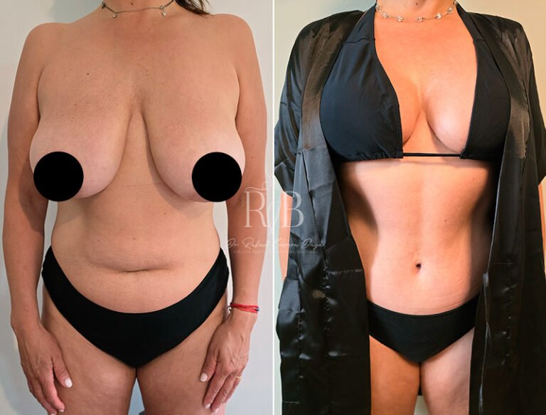 Paciente con resultados naturales y armoniosos de aumento mamario por Dr. Rafael Barrera, mejora de forma y volumen.