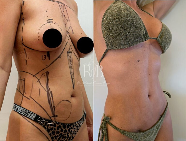 Paciente femenina con aumento mamario realizado por Dr. Rafael Barrera