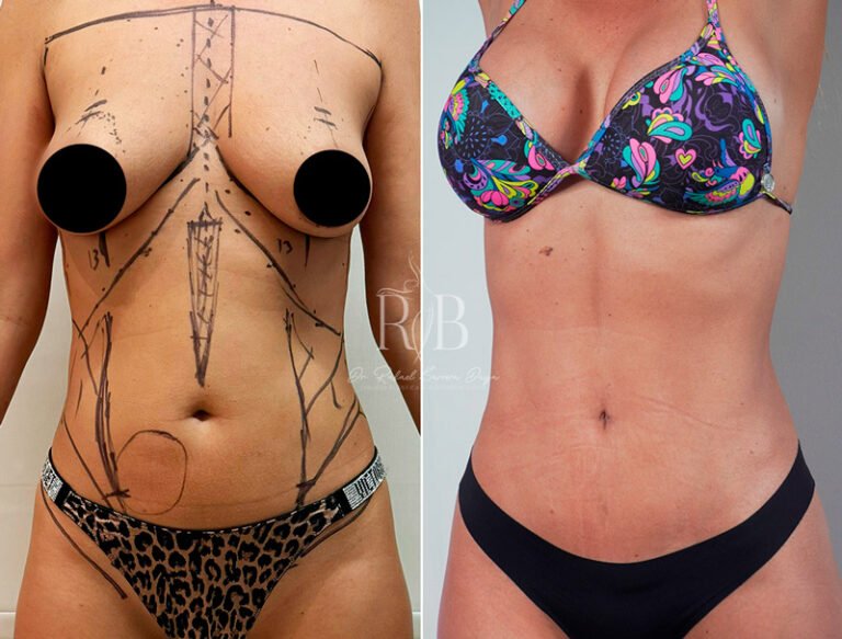 Resultados de lipoescultura en abdomen y flancos por Dr. Rafael Barrera