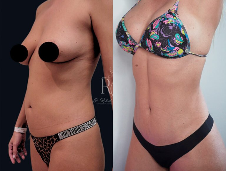 Resultados de lipoescultura en abdomen y flancos por Dr. Rafael Barrera